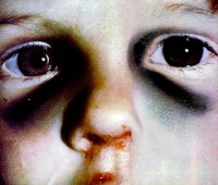 /album/consultora-medico-legal/lesiones-en-cara-nino-jpg/